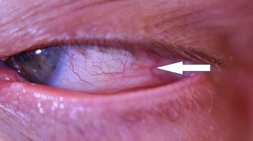 Diagnostika bielka oka
