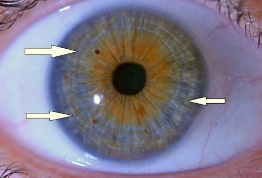 Diagnostika z oka - dúhovka